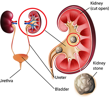 Kidney Stone